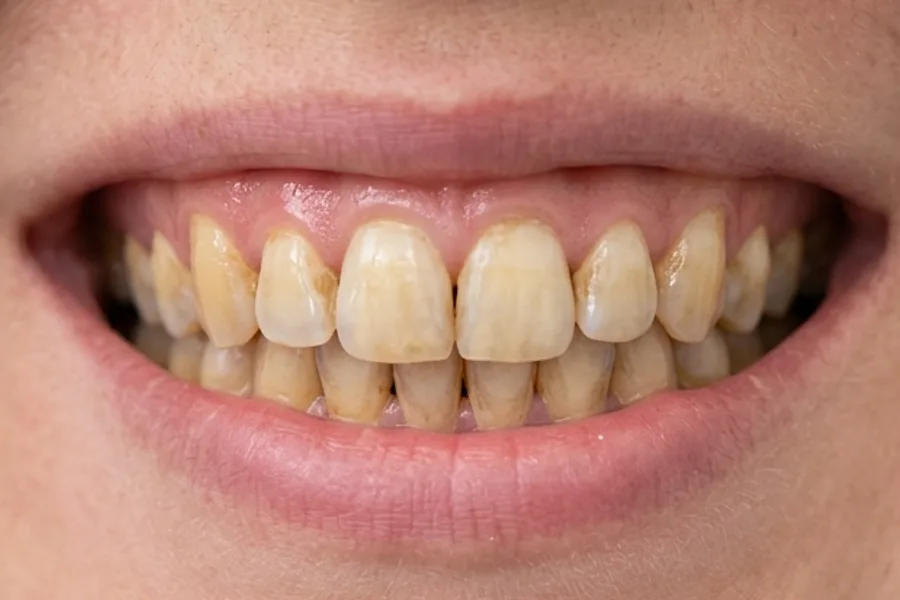 Smile showing heavily stained and discoloured teeth